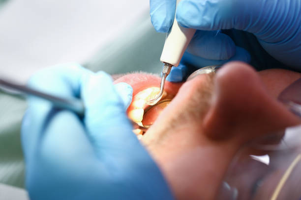 Best Emergency Wisdom Teeth Removal in Deer Park, OH