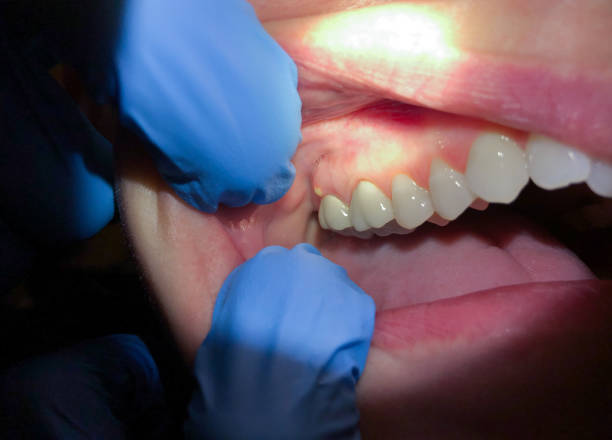 Best Emergency Treatment for Dental Infections or Abscesses in Deer Park, OH