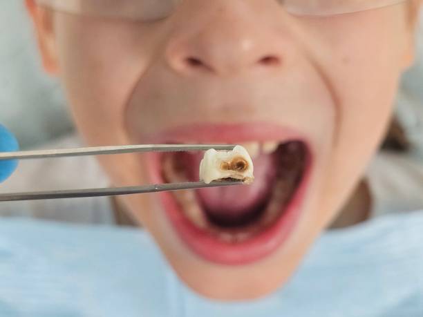 Best Emergency Dental Care for Broken or Chipped Teeth in Deer Park, OH