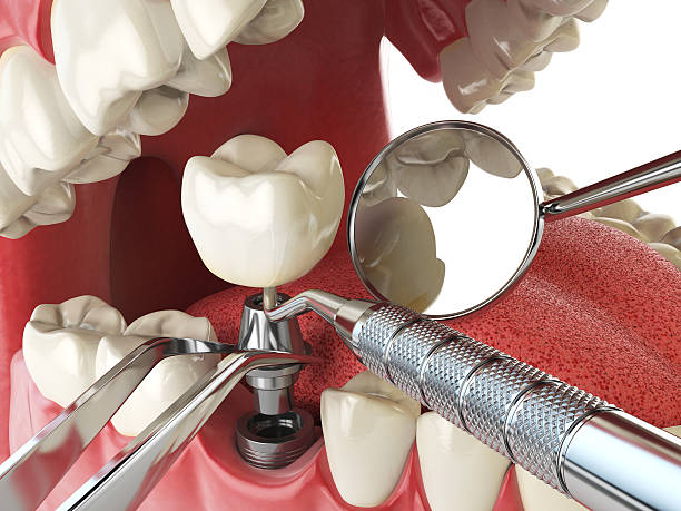 Best Emergency Denture Repair in Deer Park, OH